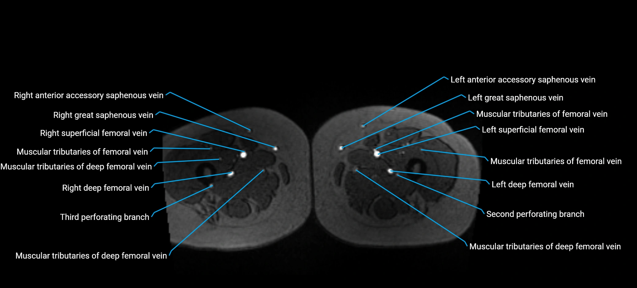 MRV abdomen pelvis & lower limb axial cross sectional anatomy labelled MRI image 243 (1).webp